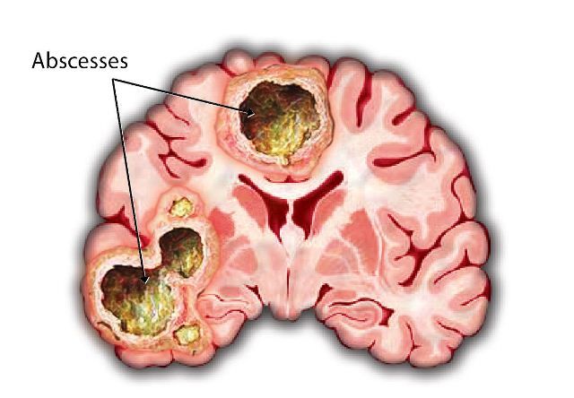 Penyebab Abses Otak: Memahami Kondisi Serius yang Memerlukan Penanganan Segera