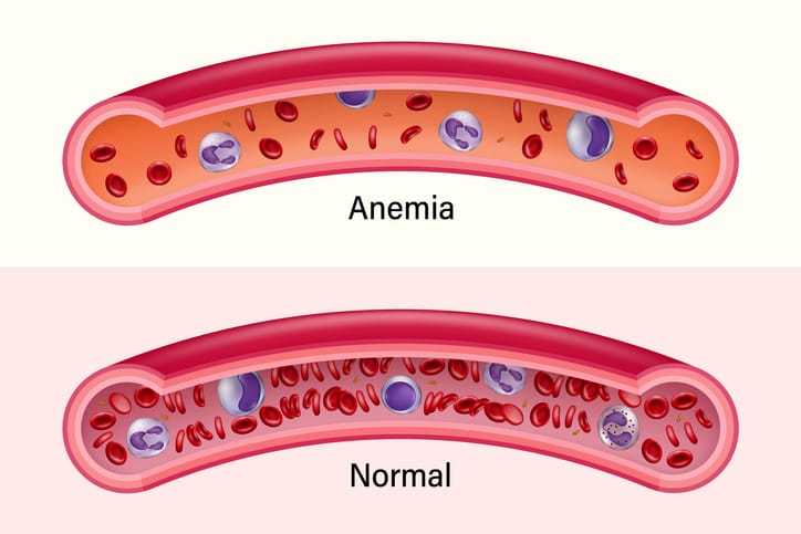 Penyebab Anemia: Memahami Masalah Kesehatan yang Umum