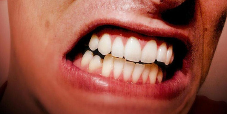 Penyebab Bruxism: Memahami Kebiasaan Menggeretakkan Gigi